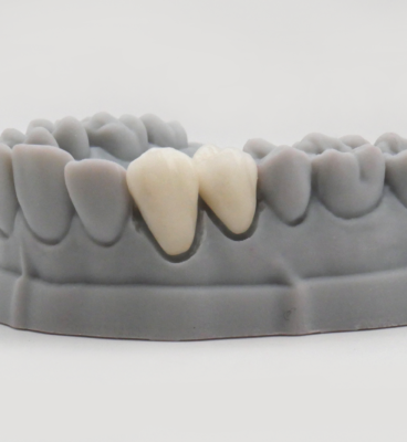 COURONE_STRATIFIE_ZIRCONIUM_01