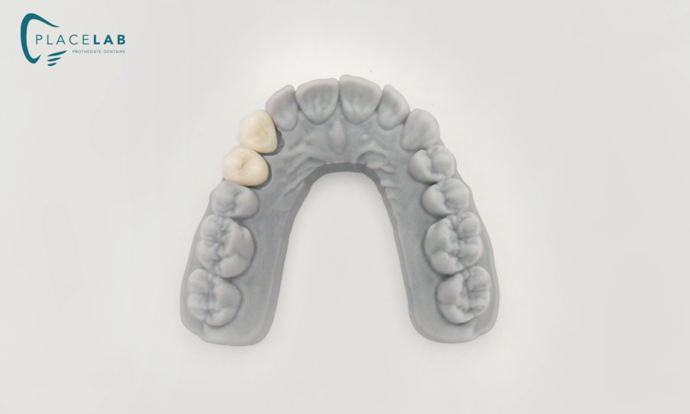 COURONE_STRATIFIE_ZIRCONIUM_02