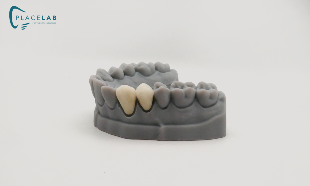 COURONE_STRATIFIE_ZIRCONIUM_04