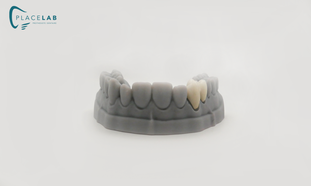 COURONE_STRATIFIE_ZIRCONIUM_05