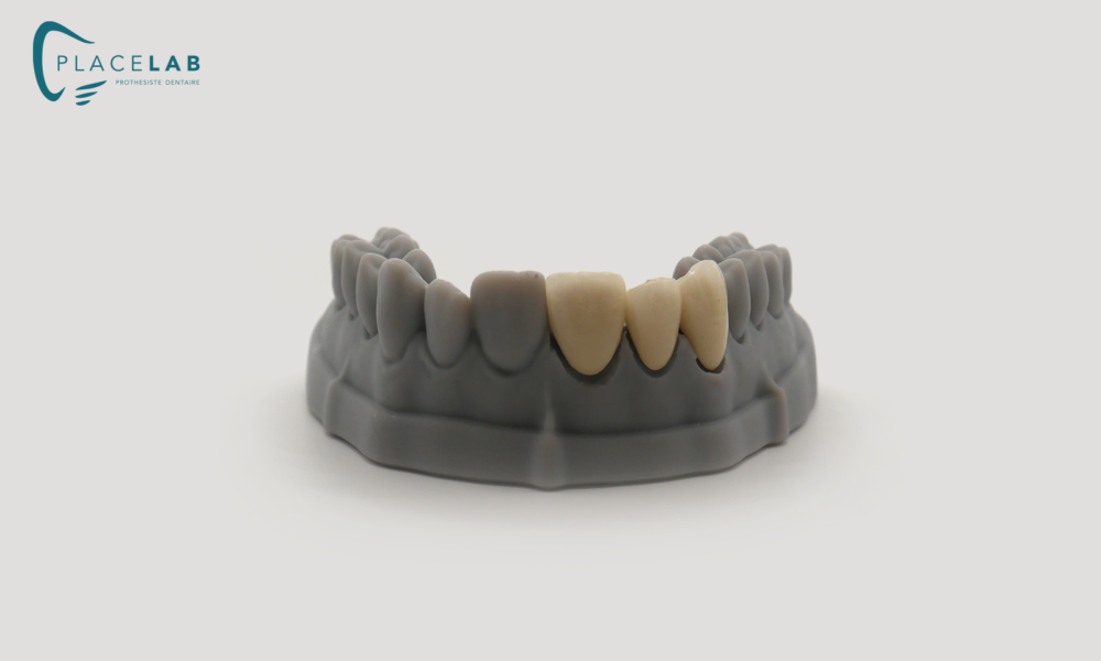 COURONNE_CERAMIQUE_METALIQUE_01