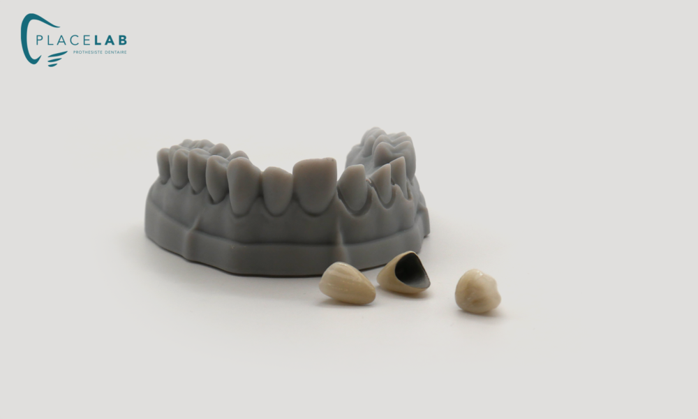 COURONNE_CERAMIQUE_METALIQUE_02
