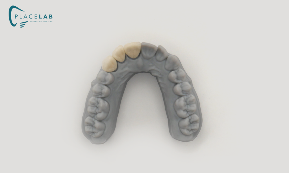 COURONNE_CERAMIQUE_METALIQUE_04