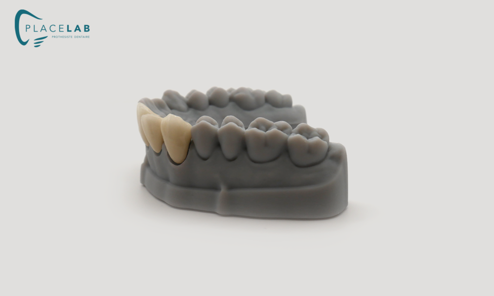 COURONNE_CERAMIQUE_METALIQUE_05