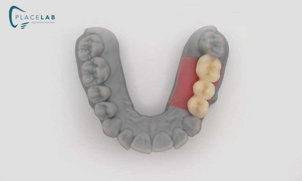 COURONNE_IMPLANTAIRE_SCELEE_02