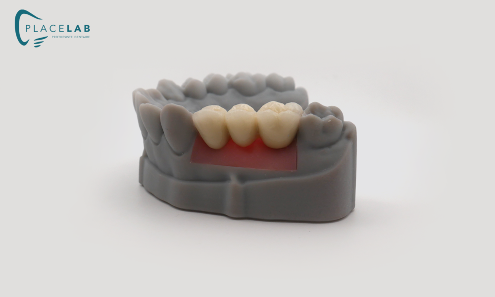 COURONNE_IMPLANTAIRE_SCELEE_03