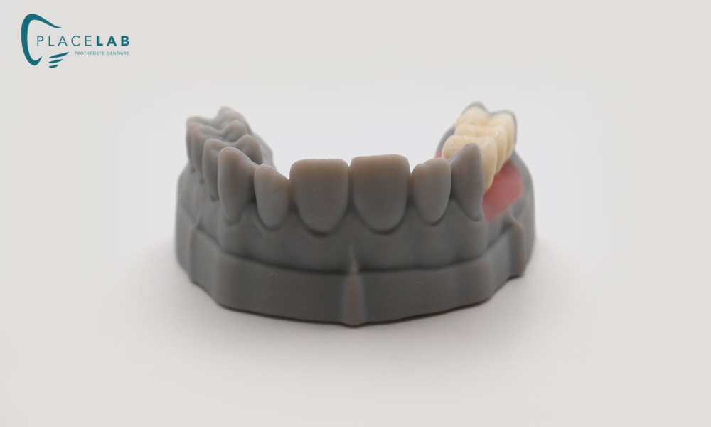 COURONNE_IMPLANTAIRE_SCELEE_04