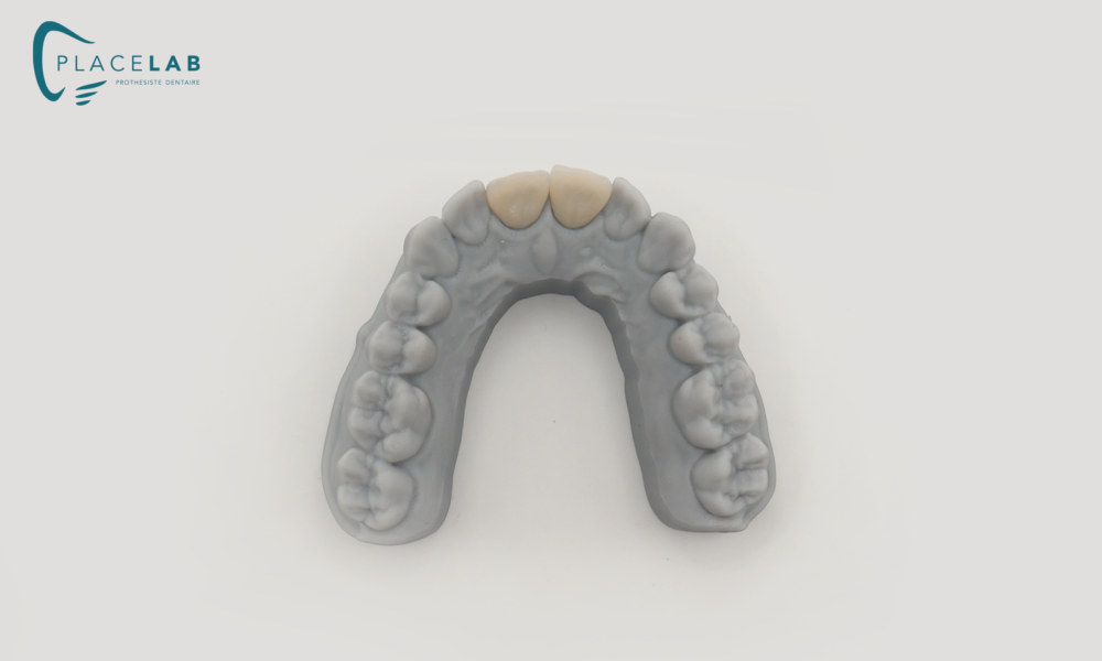 Couronne_IPS_EMAX_01
