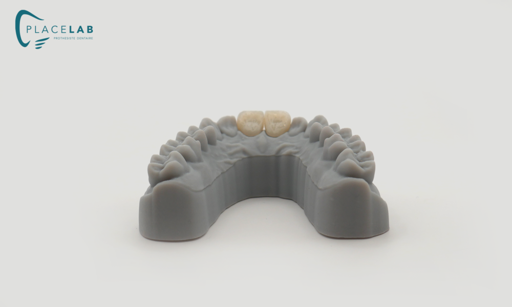 Couronne_IPS_EMAX_02