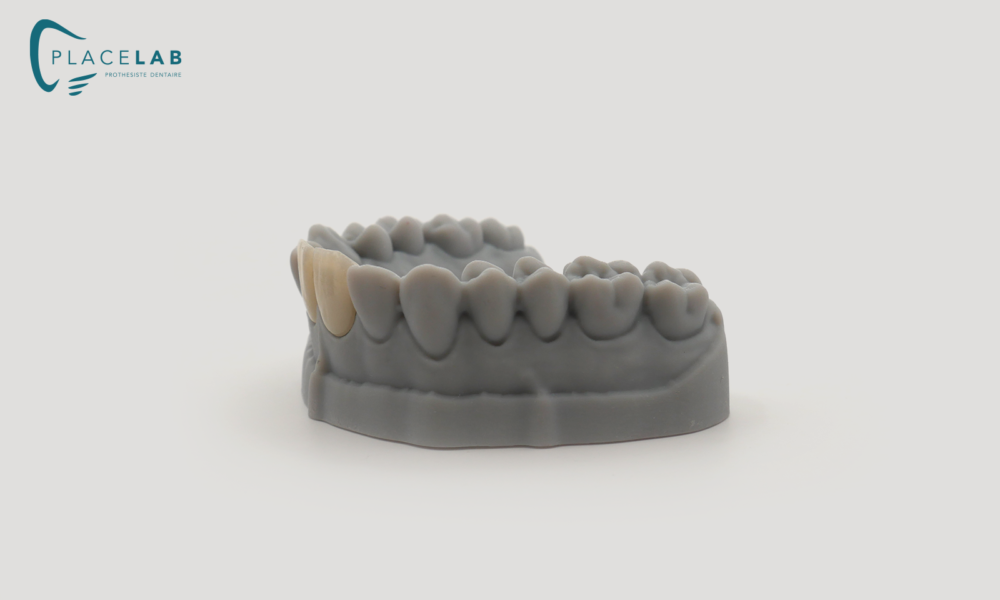 Couronne_IPS_EMAX_03
