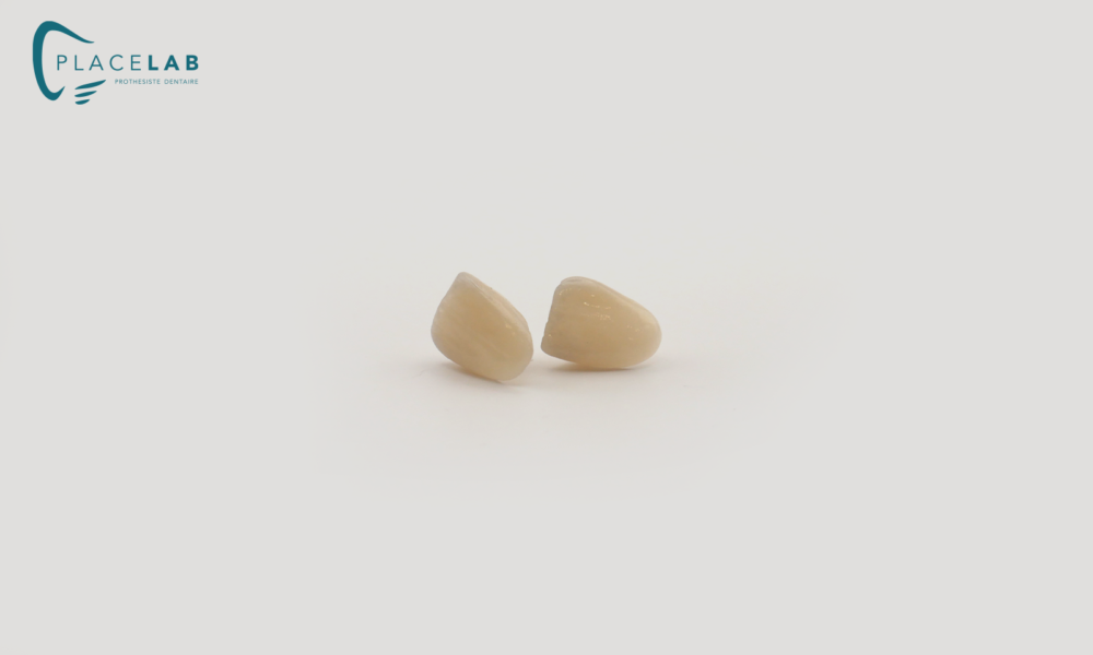 Couronne_IPS_EMAX_04