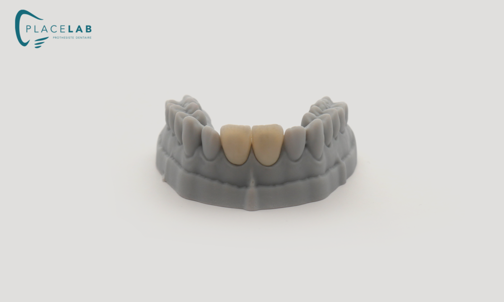 Couronne_IPS_EMAX_05