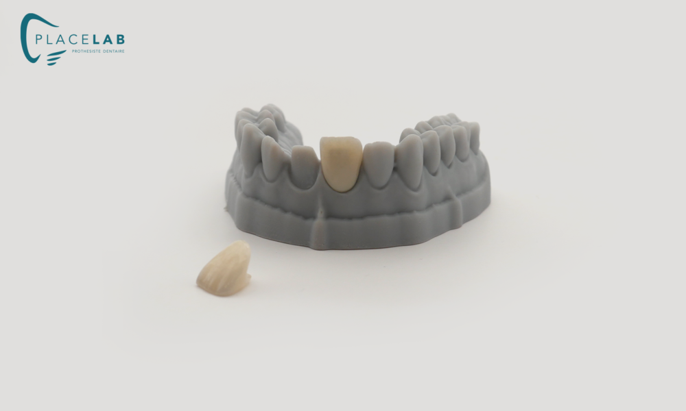 Couronne_IPS_EMAX_06