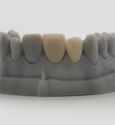 FACETTE_EMAX_06