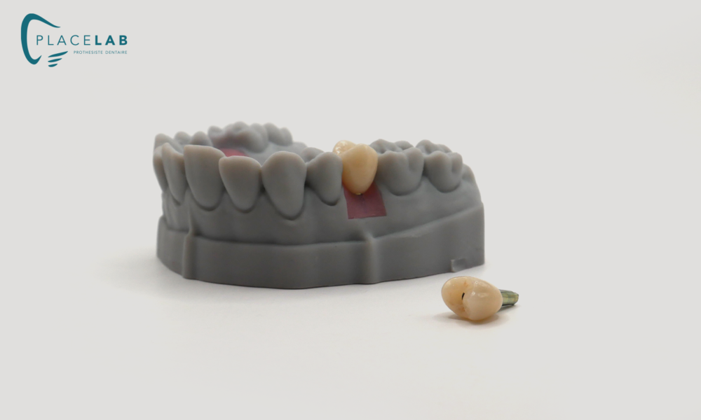 IMPLANT_EMAX_TRANSIVISE_03