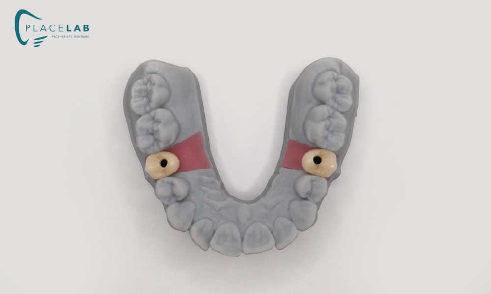 IMPLANT_EMAX_TRANSIVISE_04