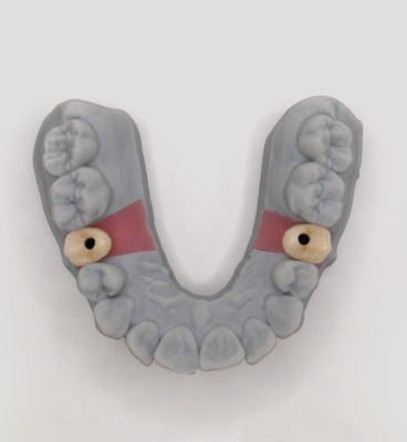 IMPLANT_EMAX_TRANSIVISE_04