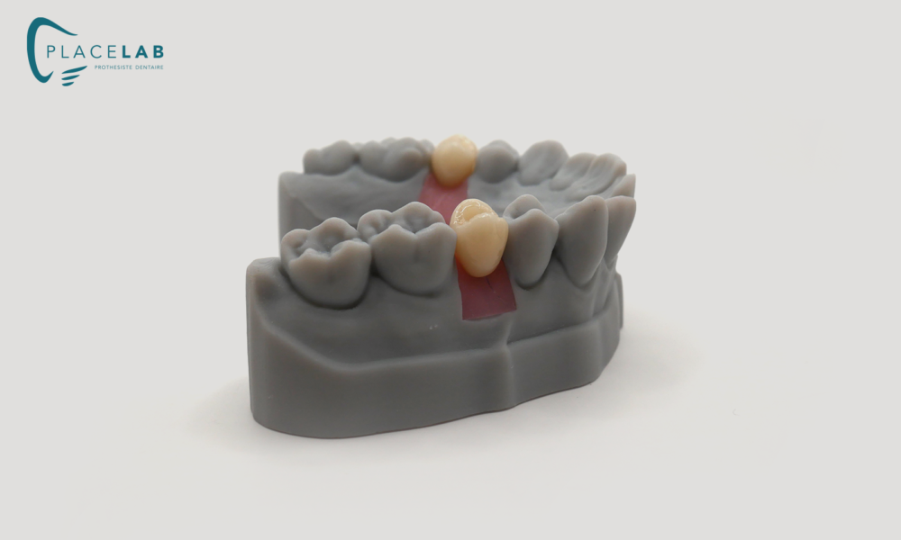 IMPLANT_EMAX_TRANSIVISE_05
