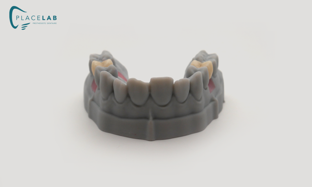 IMPLANT_EMAX_TRANSIVISE_06