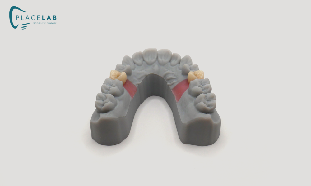 IMPLANT_EMAX_TRANSIVISE_07